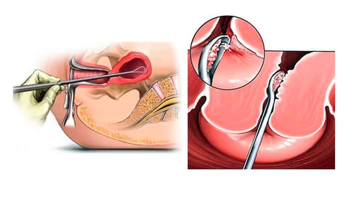 Выскабливание полости матки в Москве - цены на раздельное диагностическое  выскабливание (РДВ) матки - МедЦентрСервис