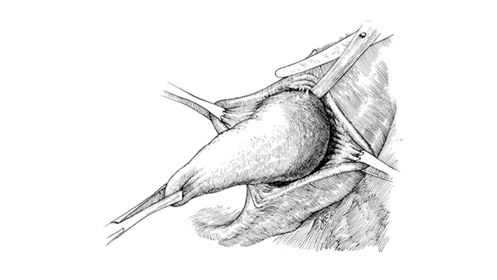 Удаление кисты бартолиновой железы