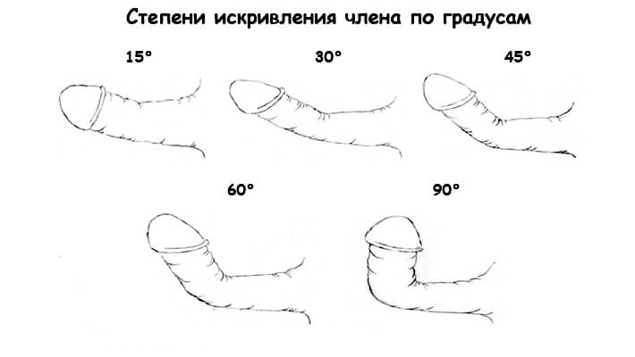 Искривление полового члена