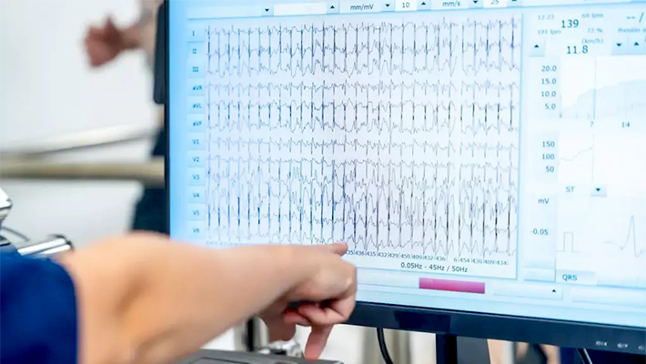 Синусовая аритмия