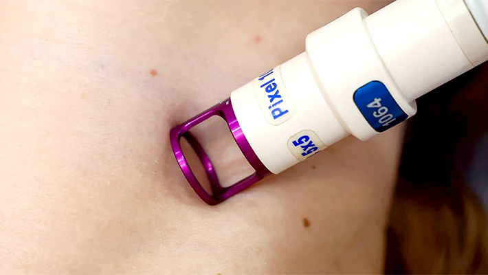 Лазерное удаление контагиозного моллюска