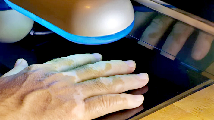 Фототерапия кожи