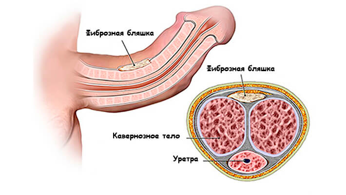 Фиброзная бляшка при болезни Пейрони