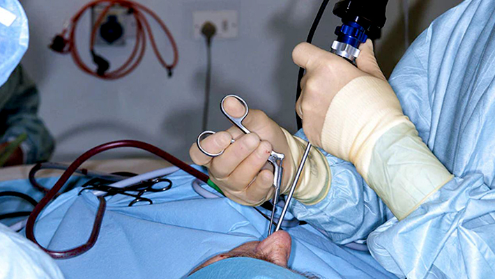 Удаление полипов в носу лазером