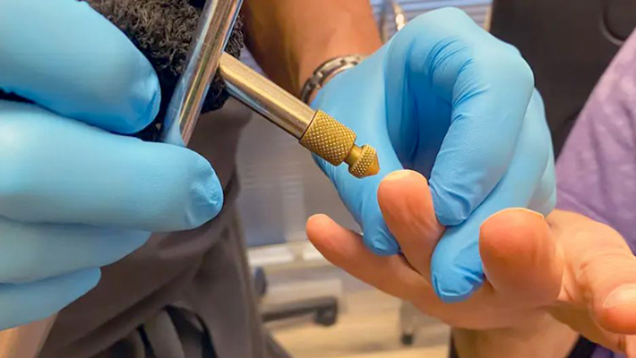 Удаление новообразований жидким азотом