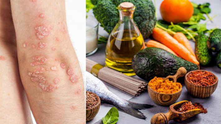 Диета при псориазе