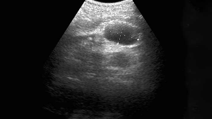 Подготовка к УЗИ забрюшинного пространства