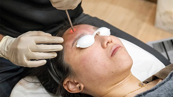 Лазерное лечение акне