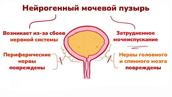 Нейрогенный мочевой пузырь