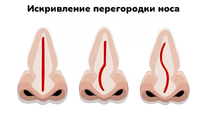 Искривление перегородки носа