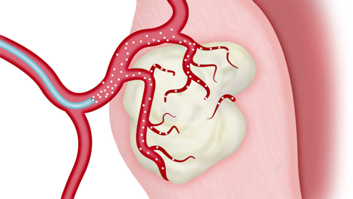 Эмболизация маточных артерий (ЭМА)