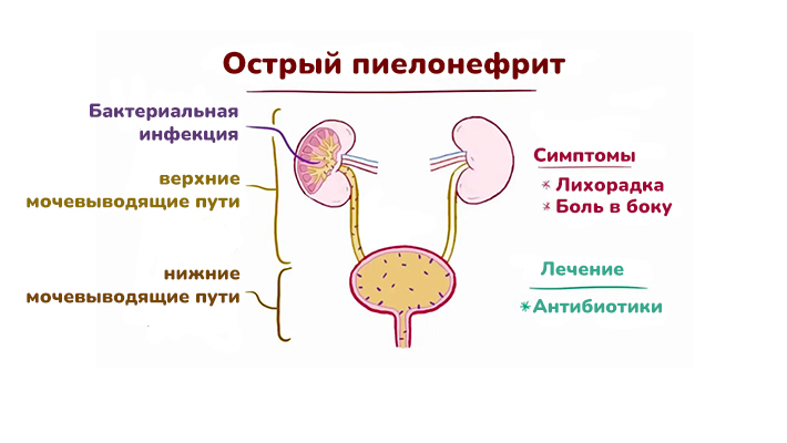 Причины острого пиелонефрита