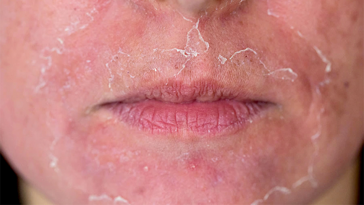 Химический пилинг лица