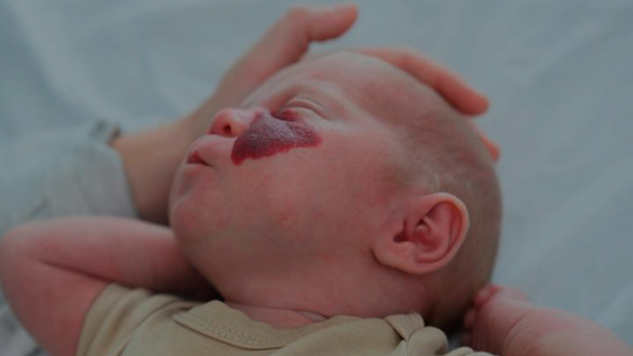 Гемангиома