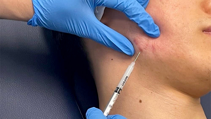 Удаление келоидных рубцов