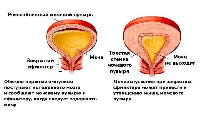 Симптомы нейрогенного мочевого пузыря