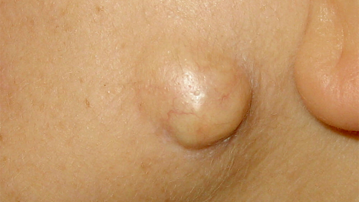 Электрокоагуляция атером