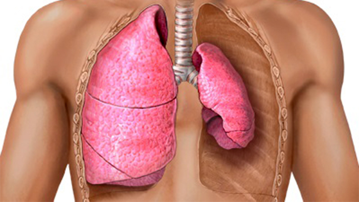 Пневмоторакс