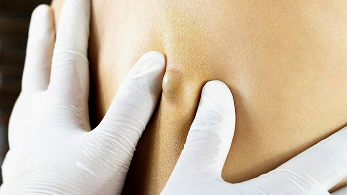 Удаление атеромы