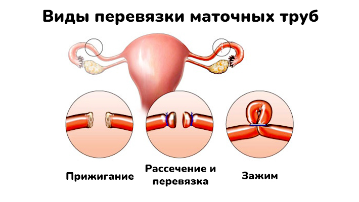 Виды перевязки маточных труб