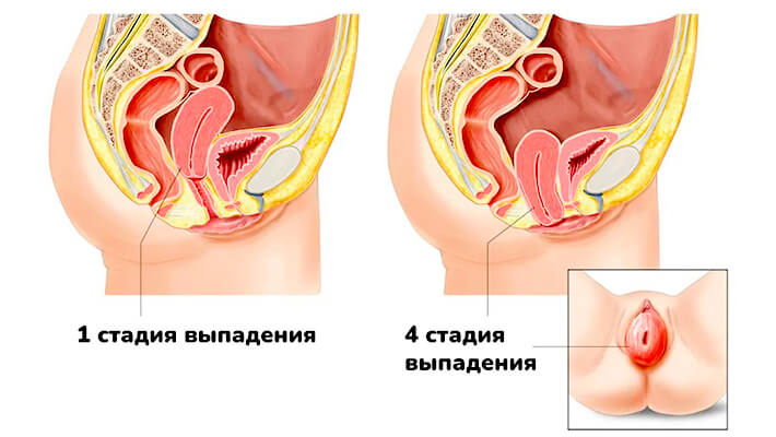 Стадии выпадения влагалища