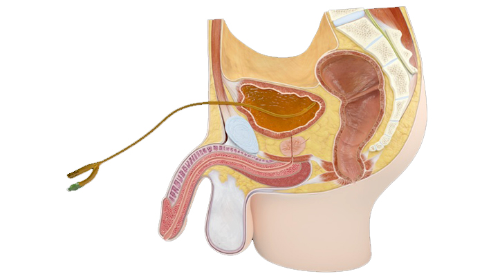 Все о катетеризации мочевого пузыря