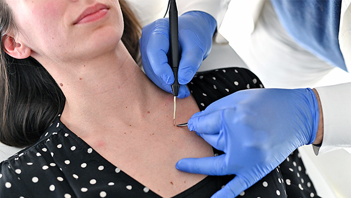 Радиоволновое удаление родинок