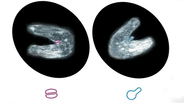 Когда видно пол ребенка по УЗИ