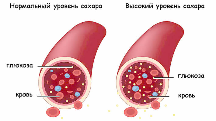 Высокий уровень сахара в крови