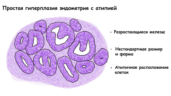 Простая гиперплазия эндометрия с атипией