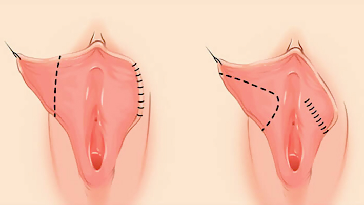 Интимная пластика половых губ