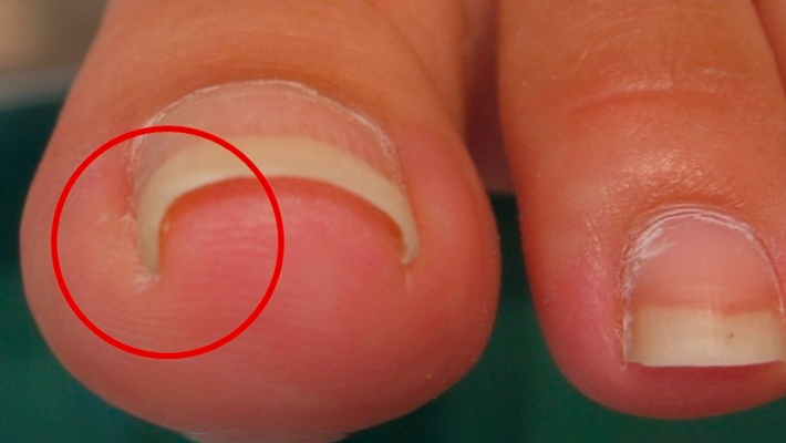 Вросший ноготь