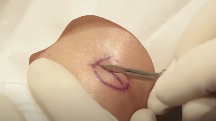 Хирургическое удаление липомы 