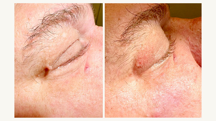 Лазерное удаление папиллом