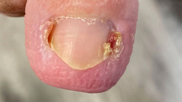 Лечение вросшего ногтя