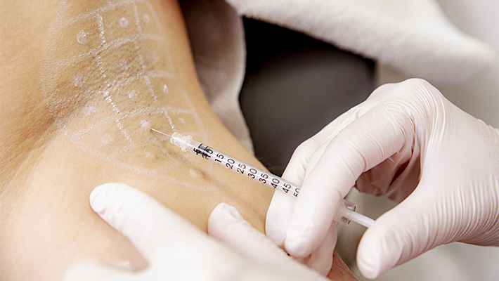 Коррекция гипергидроза ботоксом