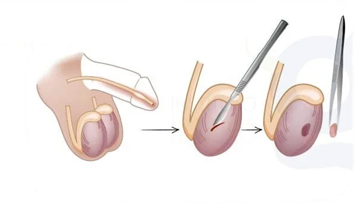 Биопсия яичка