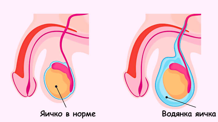 Водянка яичка