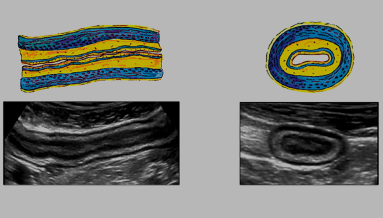 Все об УЗИ кишечника