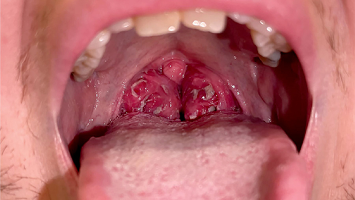 Инфекционный мононуклеоз