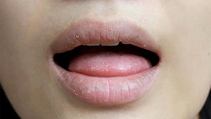 Сухость во рту