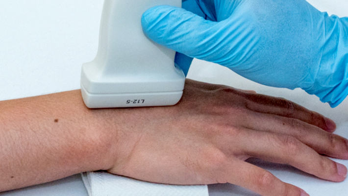 УЗИ периферических нервов