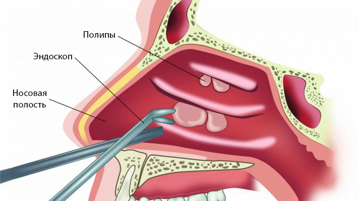 Эндоскопическое удаление полипов в носу