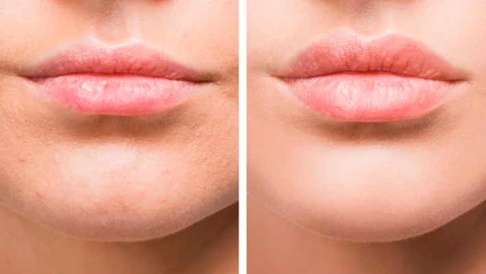 Асимметрия губ