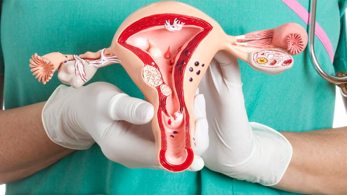 Строение матки при эндометриозе