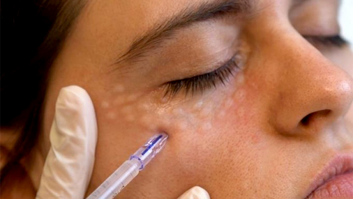 Мезотерапия кожи вокруг глаз