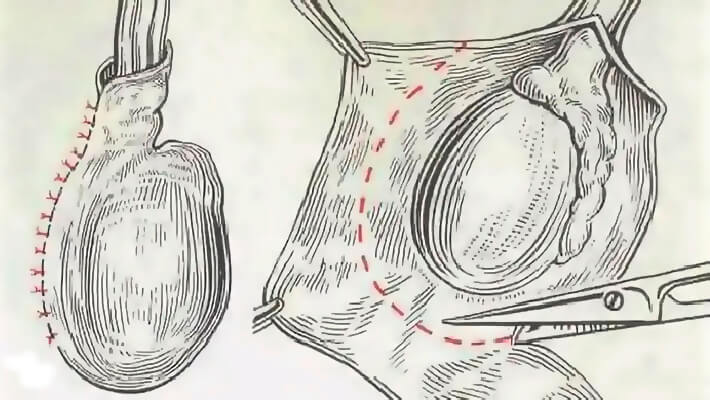 Операция при гидроцеле