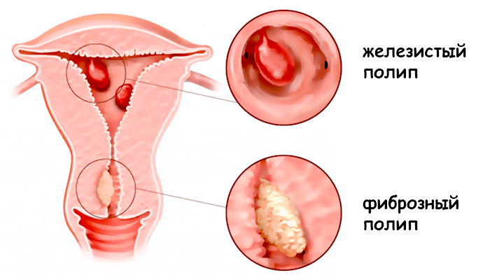Виды полипов в матке