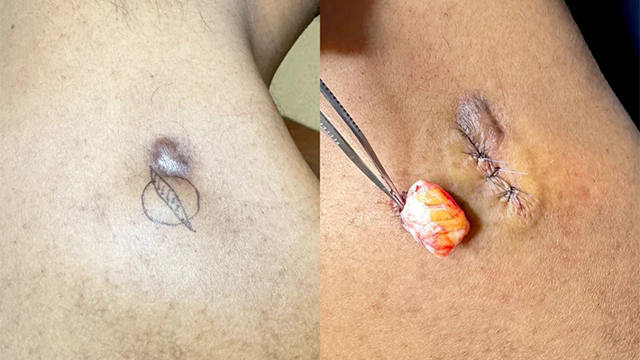 Сколько заживает атерома после удаления