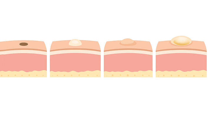 Шишка на половых губах